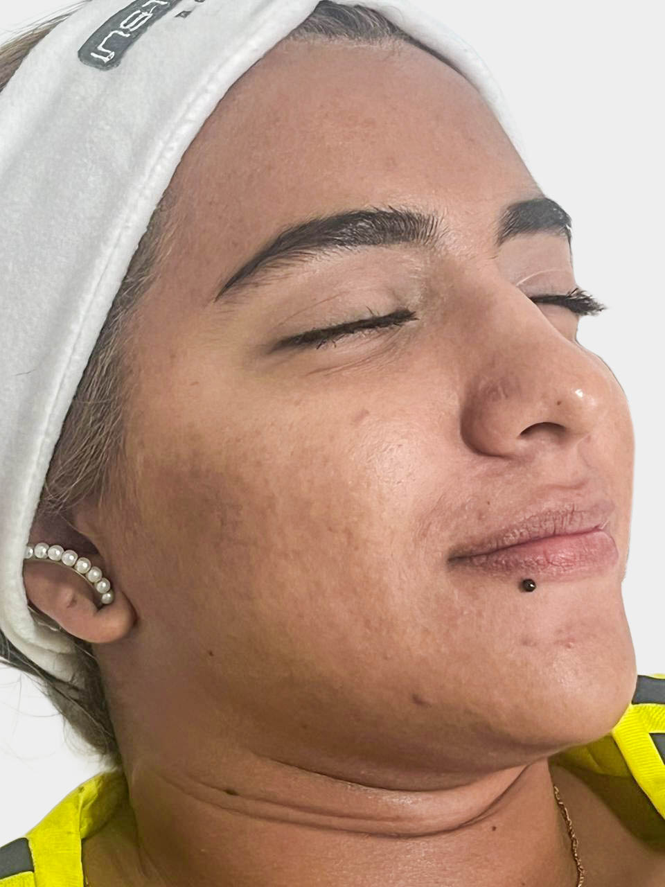 Después de Tratamiento Acné